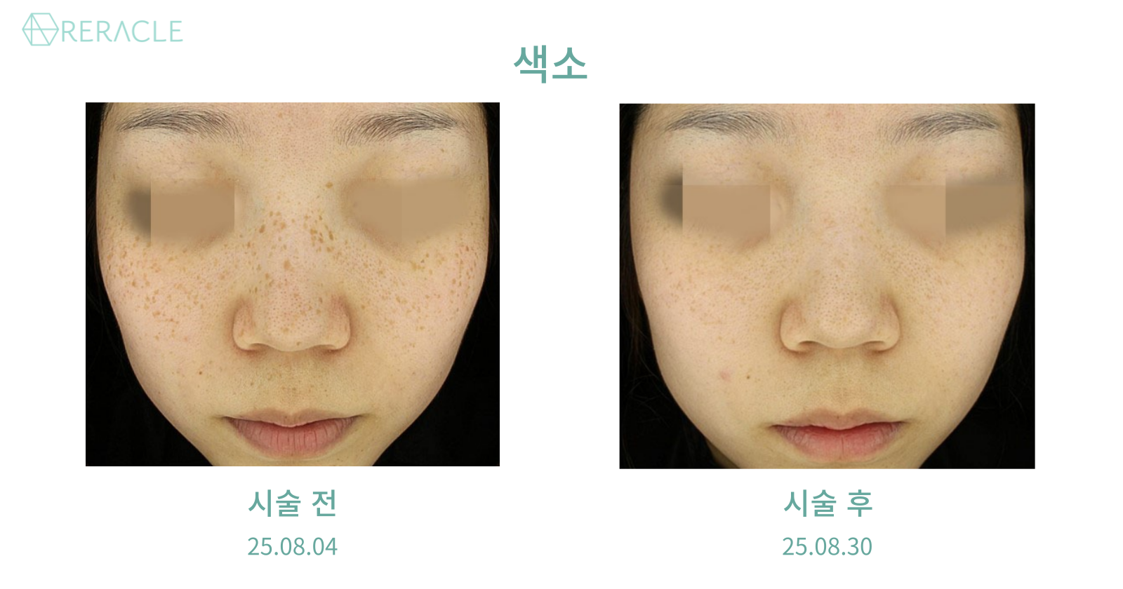 리라클의원 청주 피부과 진료 (보톡스, 필러, 리프팅) :: 전후사진